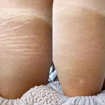 NEATCELL — Estompe les tatouages et les taches brunes à domicile