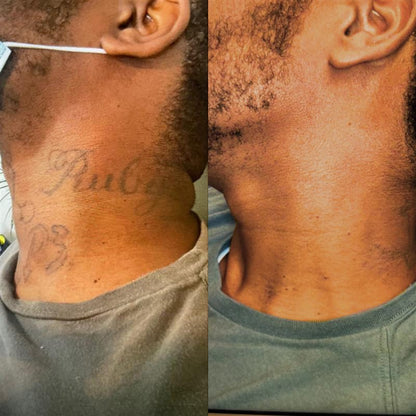 NEATCELL — Estompe les tatouages et les taches brunes à domicile