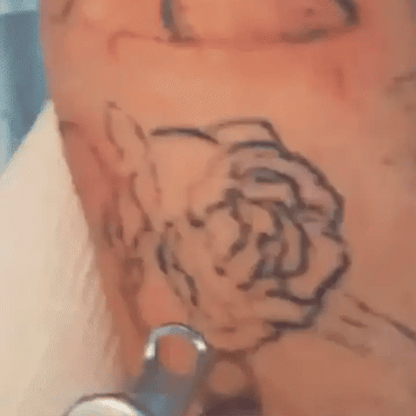 NEATCELL— Fade Tattoos & Dark Spots at Home