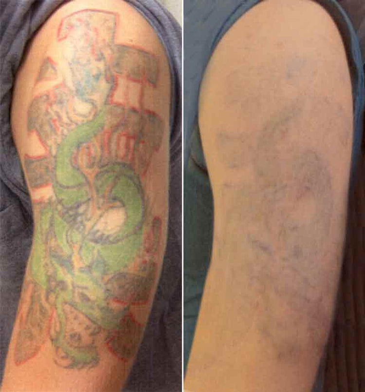 Before and after: upper arm tattoo