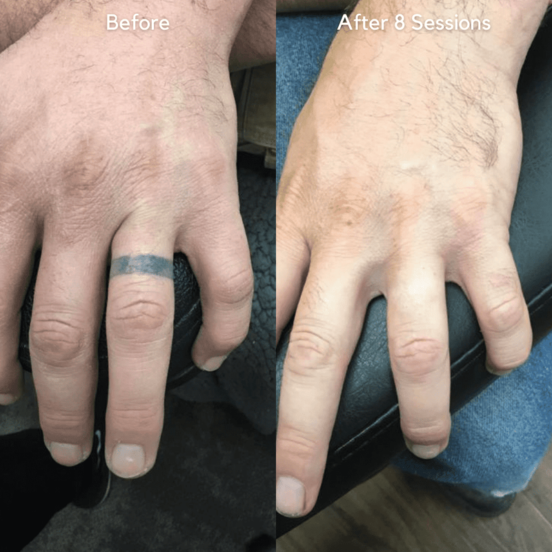 Tattoo removal information and device visuals